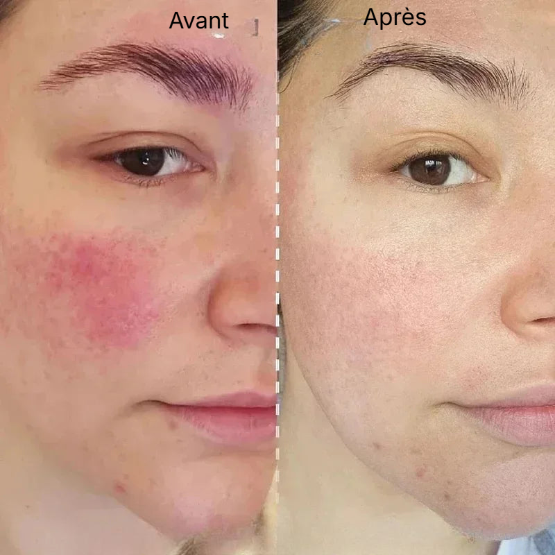 Crème Anti-Rougeur Visage - Centella