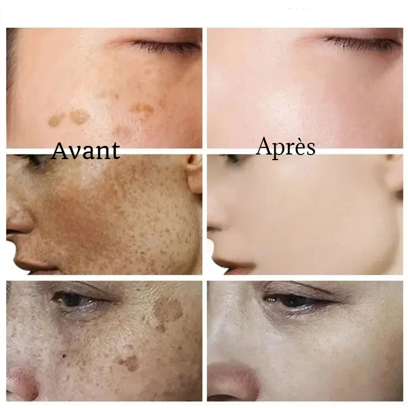 Crème Anti-tache Visage et Corps - FRECKLE