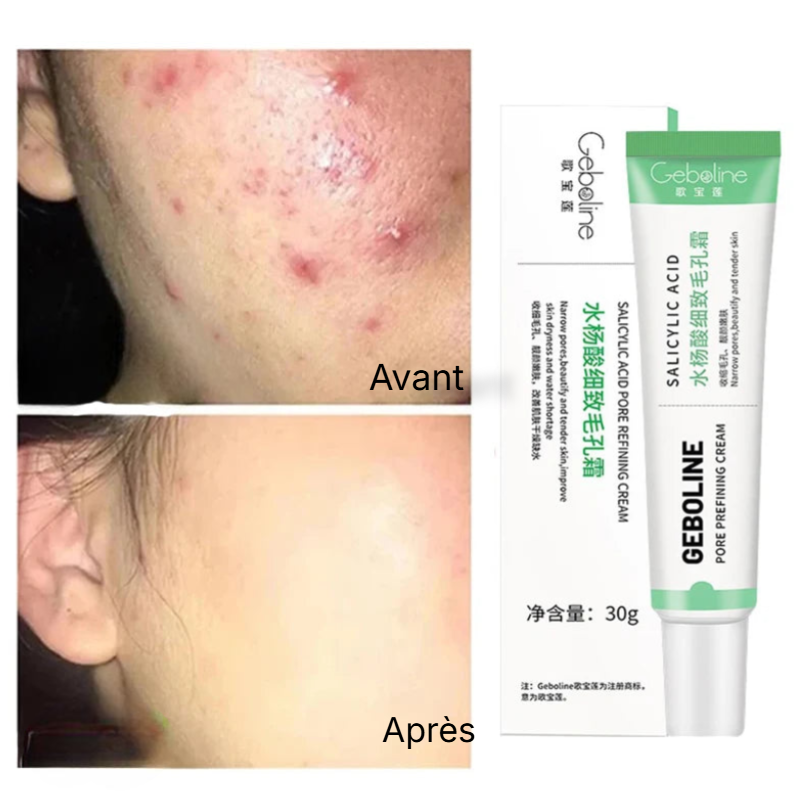 Crème pour Bouton Visage - GEBOLINE