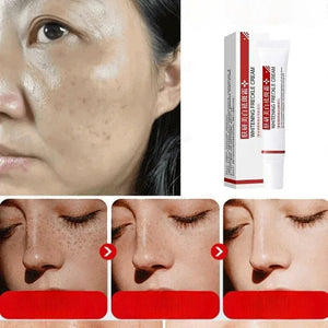 Creme pour le visage anti tache - FRECKLE